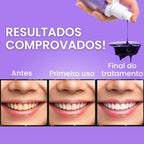 Blanqueador Dental iziSmile - Dientes Blancos en Segundos [Descuento + Entrega Gratis Hoy]