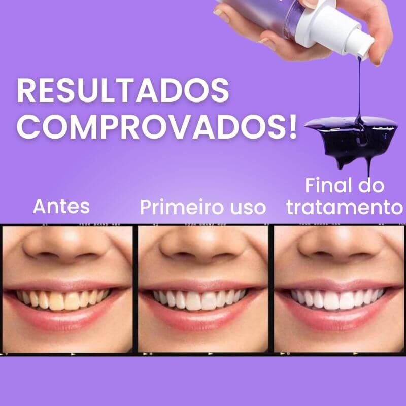 Blanqueador Dental iziSmile - Dientes Blancos en Segundos [Descuento + Entrega Gratis Hoy]