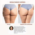 Drena Roller – Masajeador Linfático para Lipedema y Celulitis